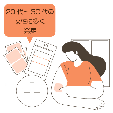 20代から30代の女性に多く発症する膠原病疾患の一つエリテマトーデス（SLE）です。