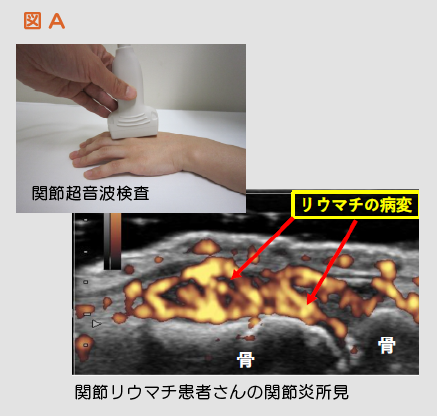 図A
超音波検査、関節リウマチ患者さんの関節炎所見