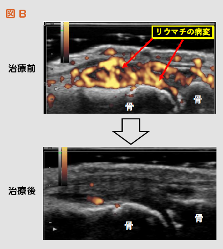 図B
リウマチ病変の治療前と治療後