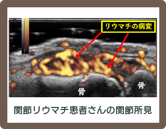 関節リウマチ患者さんの関節所見の写真